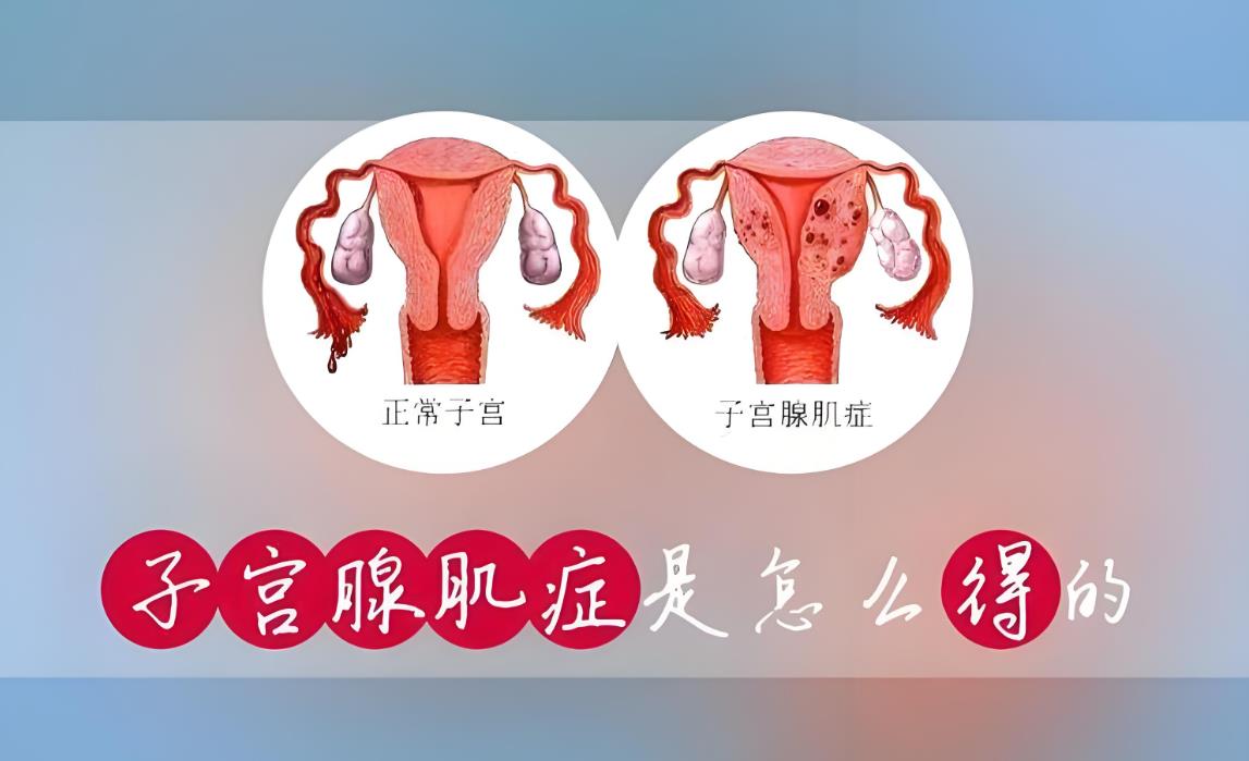 什么是子宫腺肌症,腺肌症介绍及对生育的影响