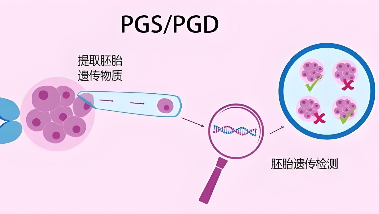 5个囊胚pgs筛查全军覆没,pgs筛查会淘汰多少囊胚