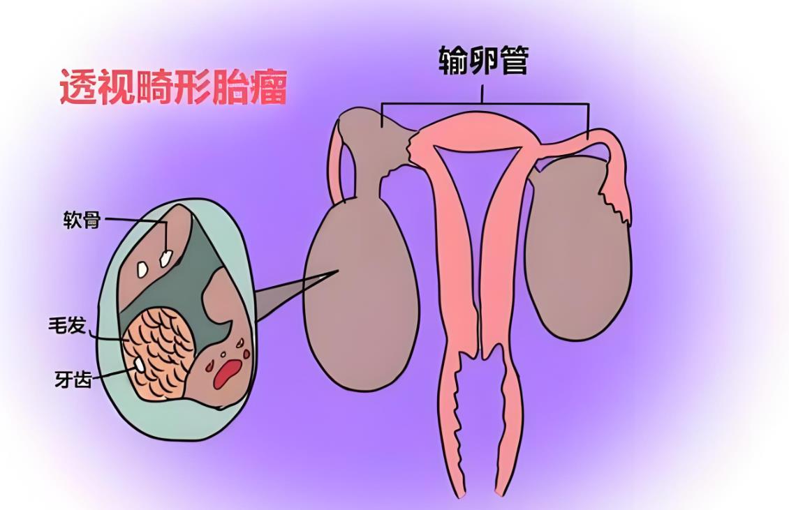 卵巢畸胎瘤影响生育吗,卵巢畸胎瘤手术后多久可以怀孕