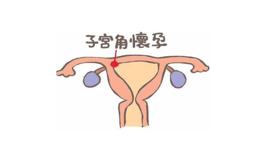 偏右侧宫角妊娠怎么办,宫角妊娠以后还能正常怀孕吗